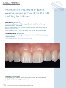 Interceptive treatment of tooth wear: a revised protocol for the full molding technique (EN)
