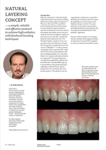 Natural Layering Concept — a simple, reliable and effective protocol to achieve high esthetics with freehand bonding techniques (EN)